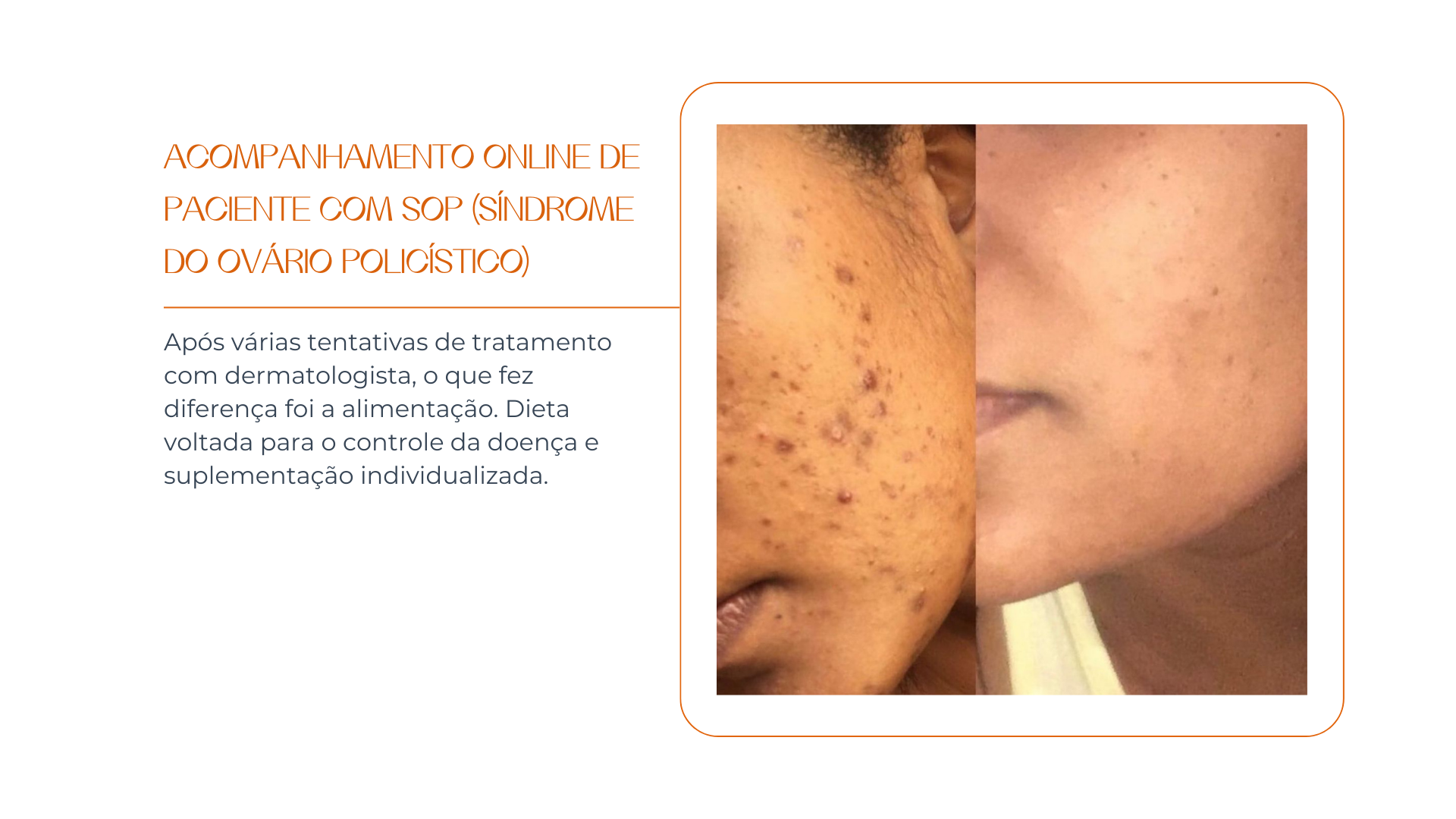 Nutricionista em Brasilia Nutricionista Nutricionista boa Nutricionista bem avaliada Ana Teixeira nutricionista para saúde da mulher nutrição para SOP e endometriose plano alimentar para menopausa recomposição corporal feminina acompanhamento nutricional para lipedema nutricionista especializada em hormônios femininos nutrição individualizada para mulheres caneta emagrecedora e plano alimentar nutricionista especializada em emagrecimento acompanhamento nutricional em Brasília